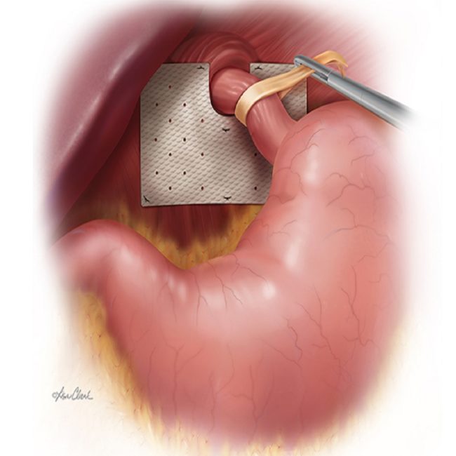 Biodesign Hiatal Hernia Graft Handr Healthcare